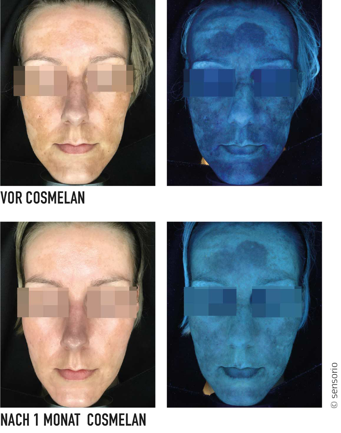 Vorher-nachher-Bild einer Frau nach Cosmelan-Behandlung – sichtbare Reduktion von Pigmentflecken in Tages- und UV-Licht.